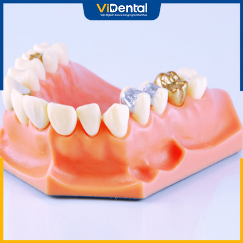 Vật liệu kim loại quý thường dùng cho răng hàm, tiền hàm