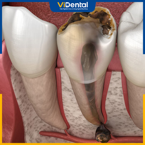 Tủy răng bị thối là hiện tượng viêm nhiễm nghiêm trọng