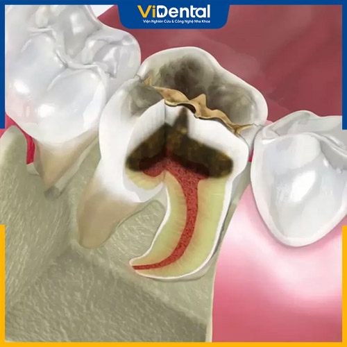 Tủy răng bị thối có phần dịch mủ chảy ra