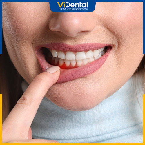 Viêm nha chu gây ảnh hưởng đến tủy răng