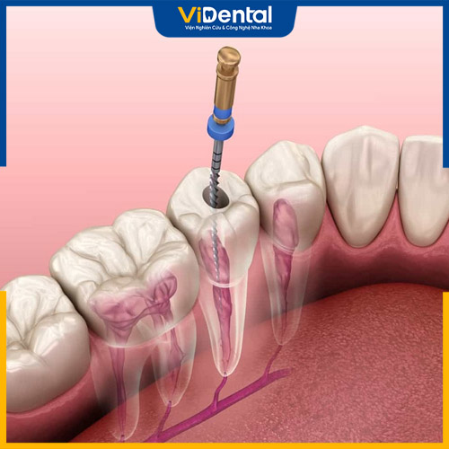 Người bệnh có thể được chỉ định lấy tủy răng