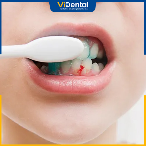 Người bệnh thường xuyên bị chảy máu khi đánh răng