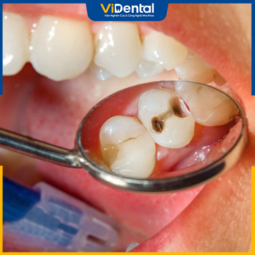 Viêm nướu không được điều trị có thể gây hỏng tủy răng