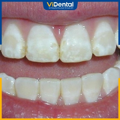 Rủi ro răng bị lệch màu do dùng bột tẩy sai cách