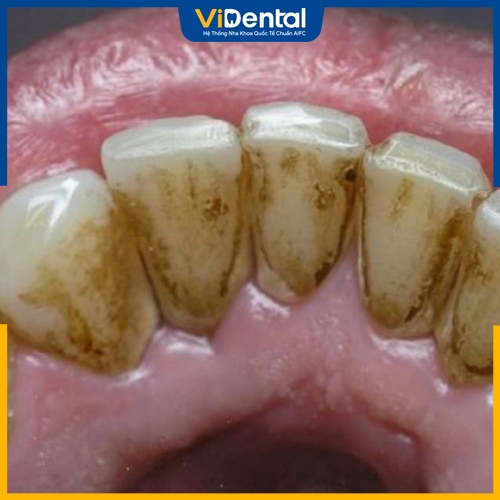 Tình trạng răng miệng ảnh hưởng lớn đến chi phí điều trị 