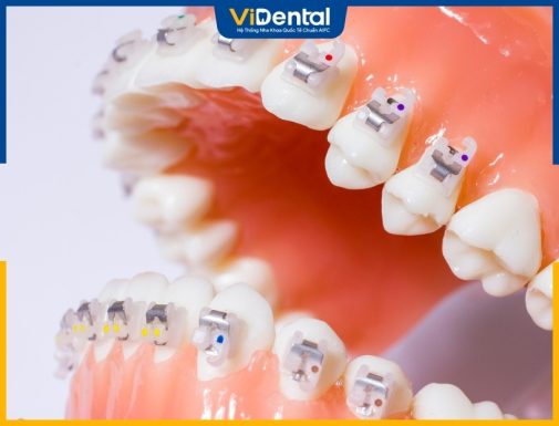 Độ Tuổi Niềng Răng Nào Mang Lại Hiệu Quả Tốt Nhất?