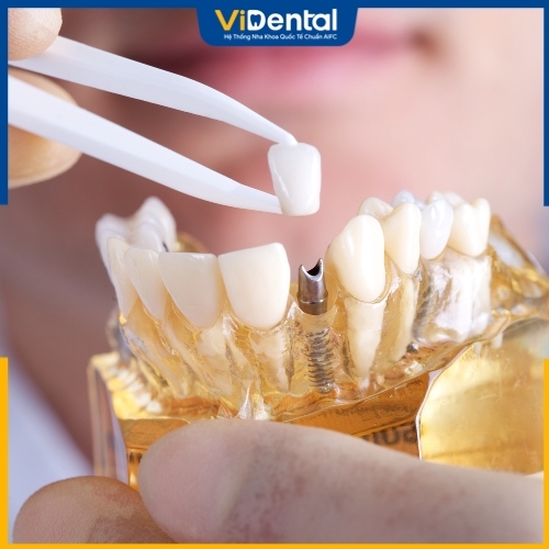 Trông Implant sớm mang lại nhiều lợi ích cho sức khỏe răng miệng