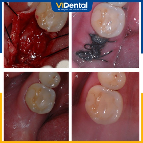 Lỗ hổng sau khi nhổ răng có thể gây nhiễm trùng nặng 