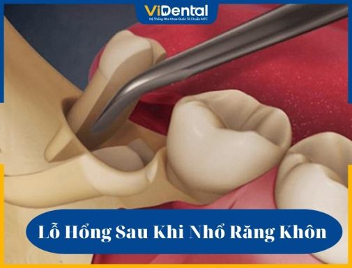 Lỗ sau khi nhổ răng khôn