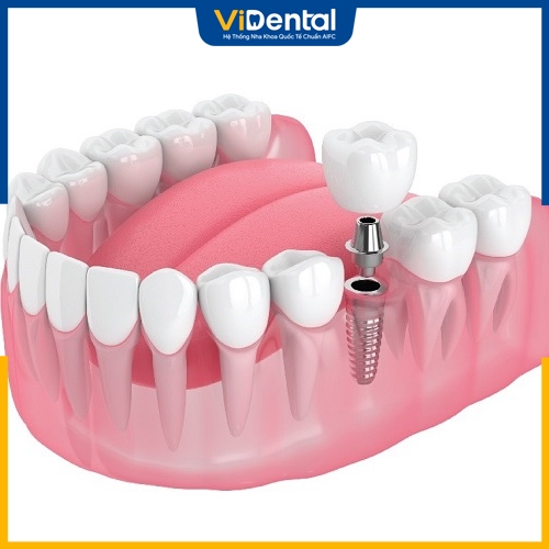 Trồng răng Implant là biện pháp khắc phục hiệu quả sau khi nhổ răng 