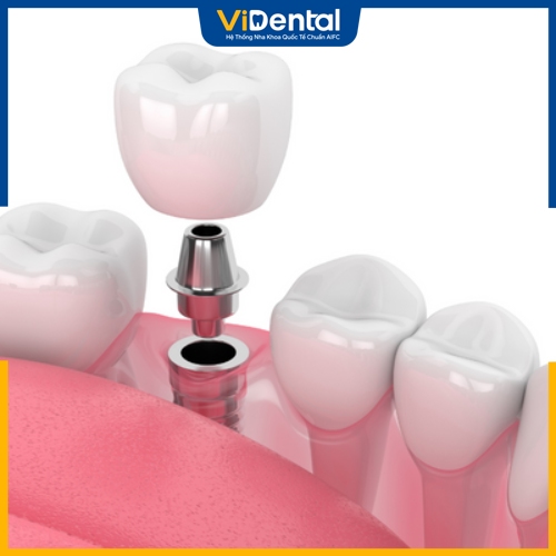 Sau khi nhổ răng khoảng 2 tháng bệnh nhân có thể trồng răng Implant 
