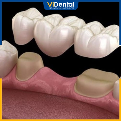 Sau khi nhổ răng có thể khắc phục bằng biện pháp cầu răng sứ 