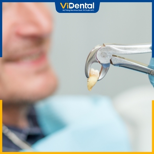 Thực hiện nhổ răng tại trung tâm nha khoa đảm bảo an toàn hơn