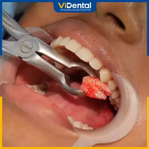 Quy trình nhổ răng số 8 cần đúng chuẩn nha khoa