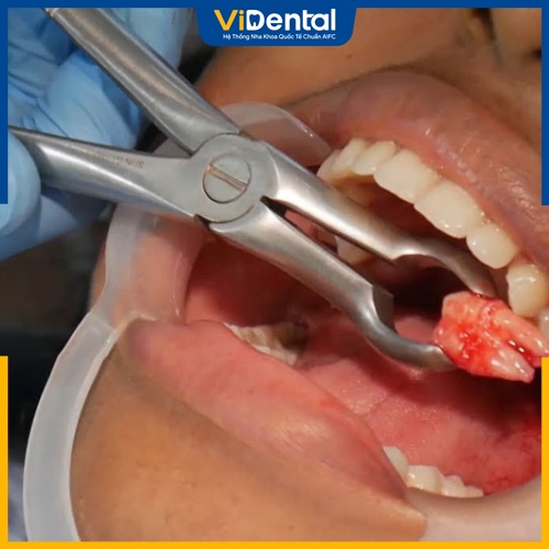 Nhổ răng số 8 sai kỹ thuật có thể gây nhiễm trùng 