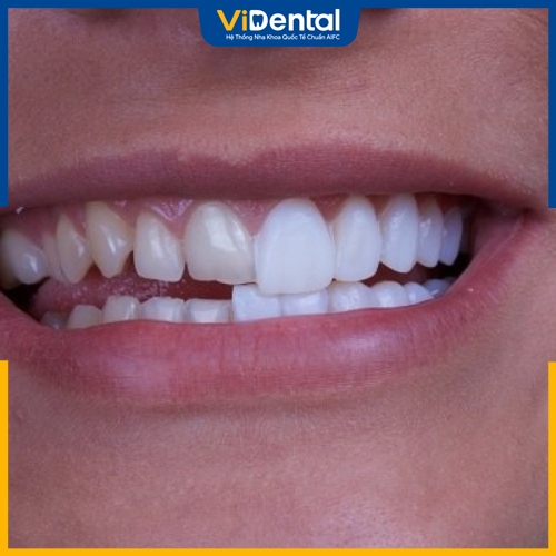 Dán răng sứ là phương pháp phục hình răng hiệu quả 