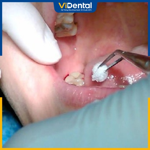 Bệnh nhân bị sai lệch khớp cắn cần nhổ răng khi niềng