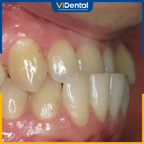 Niềng răng Invisalign mất bao lâu tùy thuộc vào tình trạng răng