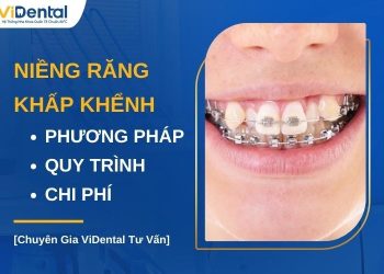 Niềng răng khấp khểnh mất bao lâu