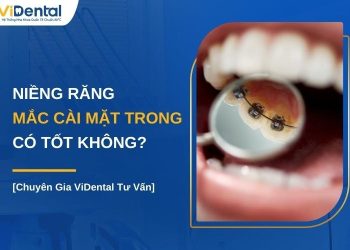 Niềng răng mắc cài mặt trong tốt không