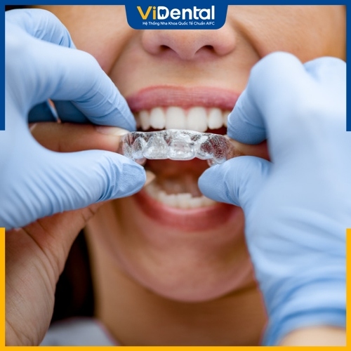 Chuyên gia giải đáp niềng răng trong suốt có cần nhổ răng không