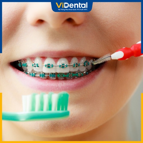 Vệ sinh răng miệng đúng chuẩn giúp tiết kiệm thời gian niềng 