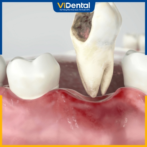 Trám răng được áp dụng cho răng sâu nhẹ 