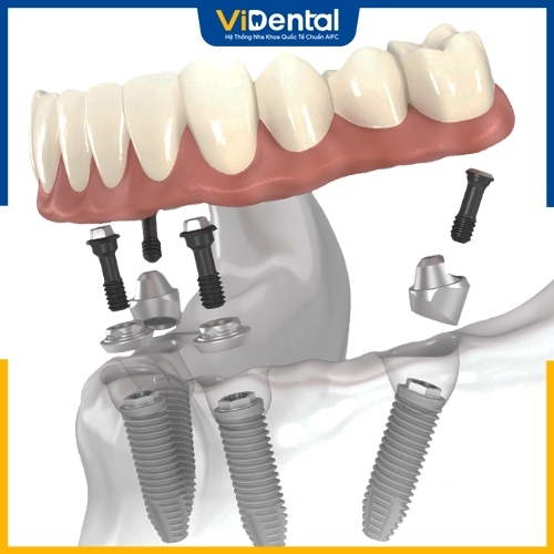 Trồng răng Implant All on 4 được đánh giá tích cực về mọi mặt