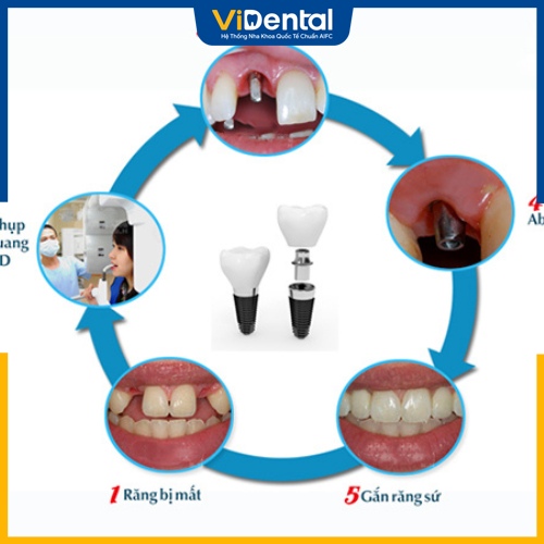 Quy trình trồng răng Implant All on 6 chuẩn Y khoa 