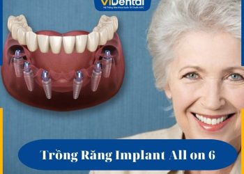 Trồng răng Implant All on 6