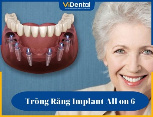 Trồng răng Implant All on 6