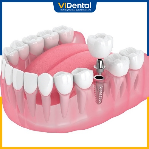 Trồng răng số 6 bằng Implant là phương pháp hiệu quả nhất 