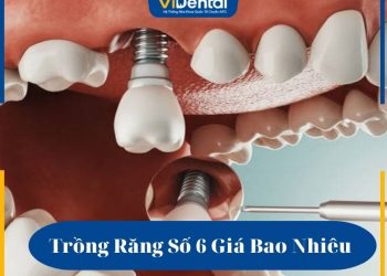 Trồng răng số 6 giá bao nhiêu