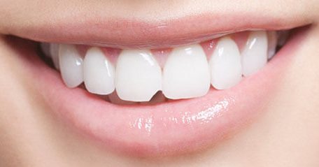 Chipped-Tooth-Repair-by-Dental-Bonding-e1521134557720