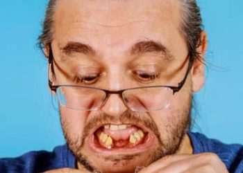 Loại hàm và răng giả tháo lắp sử dụng