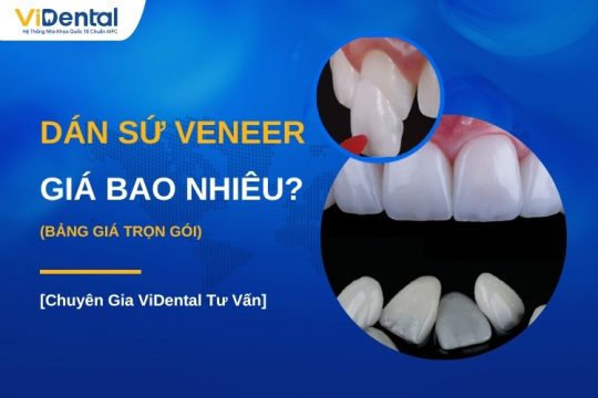 Cập nhật bảng giá dán sứ Veneer trọn gói mới nhất