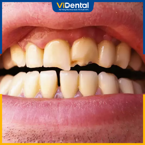 Răng sứt mẻ nhẹ có thể khắc phục bằng miếng trám
