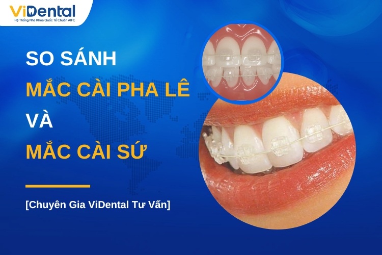 Mắc Cài Pha Lê Và Mắc Cài Sứ Có Phải 1 Loại? Đặc Điểm Từng Loại