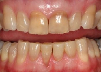 Mòn răng nhai điều trị như thế nào