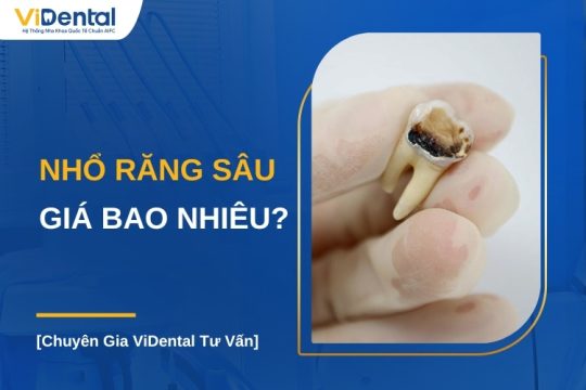 Nhổ răng sâu giá bao nhiêu