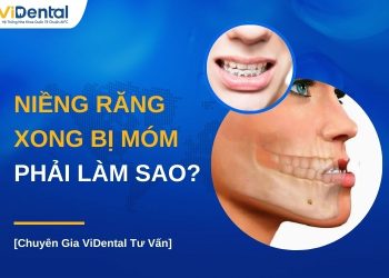 Niềng răng xong bị móm phải làm sao