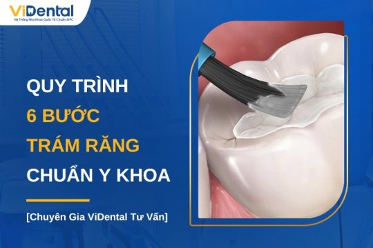 Quy trình trám răng chuẩn y khoa