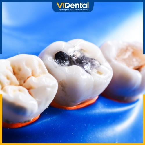 Trám răng giúp khắc phục khiếm khuyết răng nhanh chóng