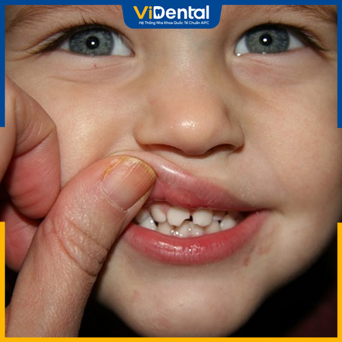 Nên trám răng cho trẻ 4, 5 tuổi bị sứt mẻ