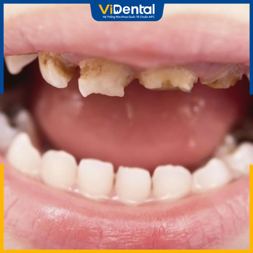 Răng bị sứt mẻ nhiều, mất gần hết răng không nên hàn