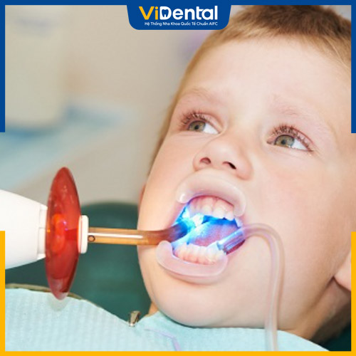 Chi phí trám răng cho trẻ 4, 5 tuổi phụ thuộc nhiều yếu tố