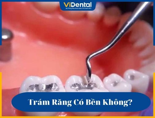 Trám răng có bền không