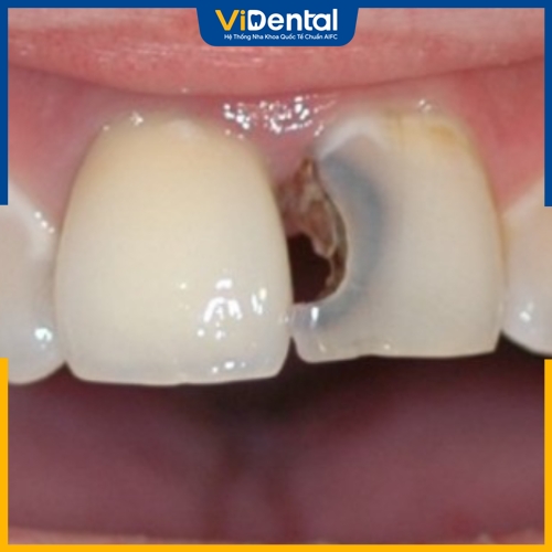 Tình trạng răng sâu nặng có thể gây đau nhức trong khi trám 
