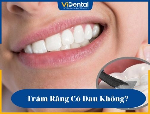 Trám răng có đau không là thắc mắc của nhiều khách hàng