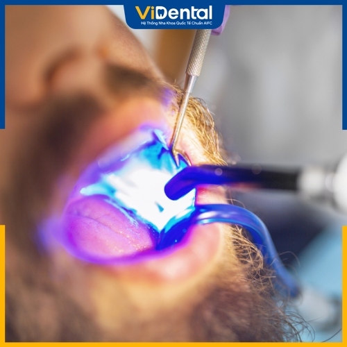Trám răng HIỆU QUẢ BỀN LÂU tại Nha khoa ViDental